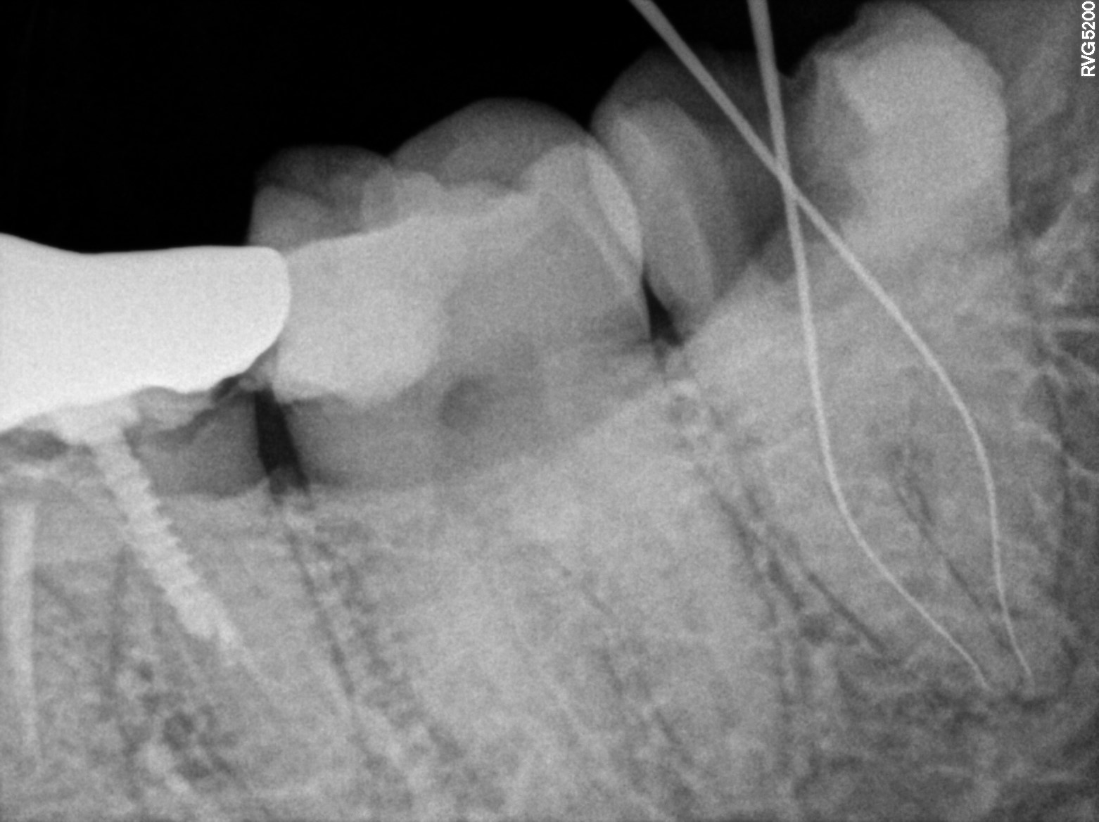 Dental X-ray